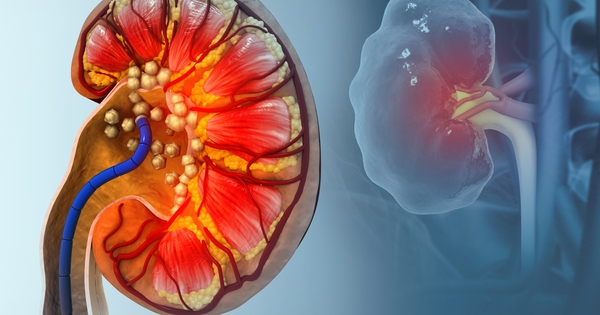 Thận chi chít sỏi chỉ vì uống 1 thứ để 