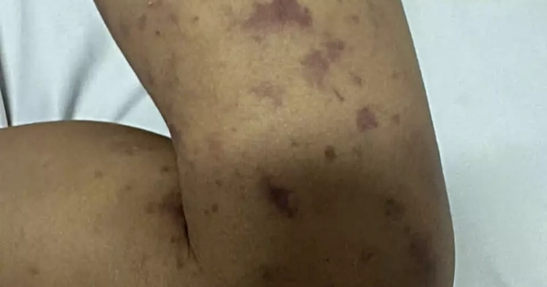 Cháu tử vong do não mô cầu, chú ruột 40 tuổi cũng nhiễm bệnh