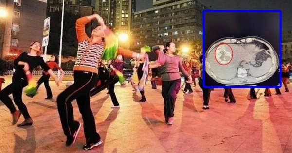 Người phụ nữ 70 tuổi vỡ khối u gan vì nhảy múa "quá mức"