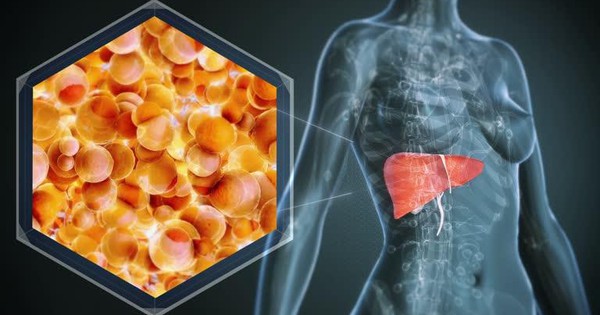 1 bệnh về gan “bùng lên”, người trẻ cũng không còn an toàn: Bác sĩ chỉ ra xu hướng điều trị mới
