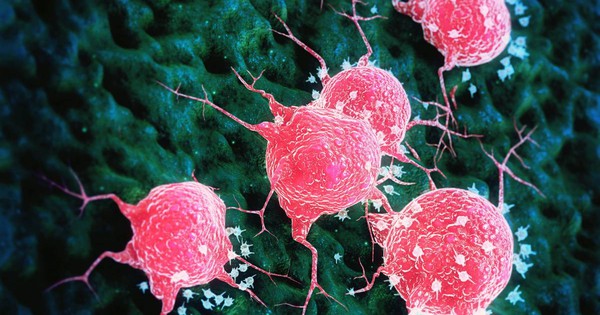 Tác nhân “châm ngòi” cho hàng nghìn ca ung thư nhưng ít ai để ý