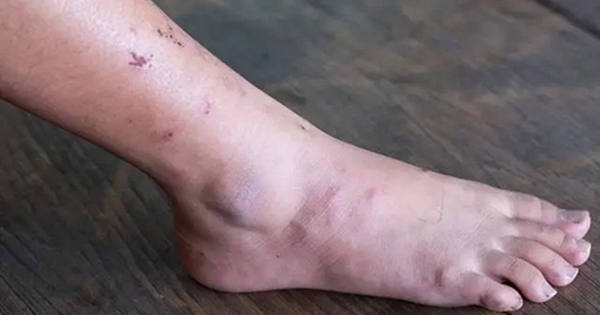 Khi ung thư mới bắt đầu hình thành, người ta thường cảm thấy 3 điều không ổn, nhưng ít ai chú ý đến