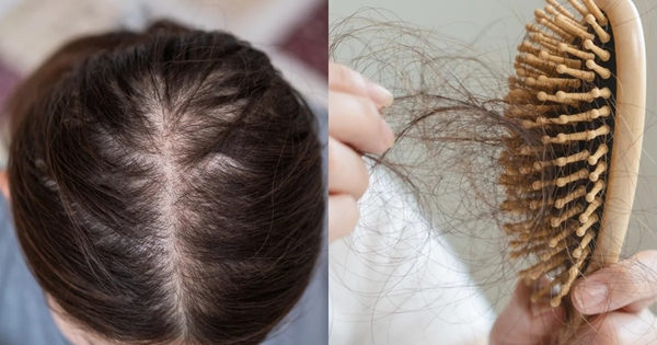 Đừng chỉ ăn trứng luộc để ngừa tóc rụng! 