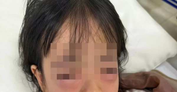 Bé gái 5 tuổi nhập viện, mắt sưng vù sau khi chơi bong bóng xà phòng