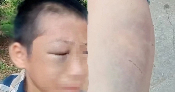 Bé trai nghi bị mẹ kế bạo hành nhiều lần, người bố lên tiếng xin lỗi nhà vợ cũ