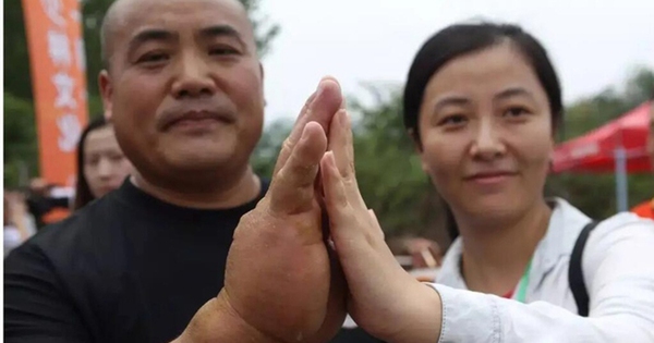 Võ sư Trung Quốc luyện thần công Kim Dung suốt 20 năm, bàn tay dày 8cm