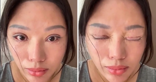 Phẫu thuật mí mắt hỏng, nạn nhân còn bị kiện ngược