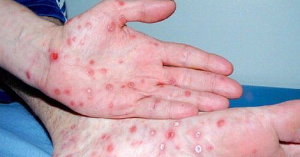 TPHCM: Số người mắc bệnh giang mai tăng đột biến
