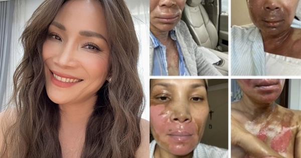 Xót xa nữ nghệ sĩ đình đám bị bỏng nghiêm trọng vì nổ nồi xông hơi: 