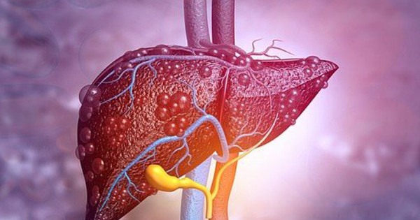 Lá gan xơ xác, suy hỏng chỉ vì 1 thói quen: Nhiều người Việt tưởng tốt, làm mỗi ngày