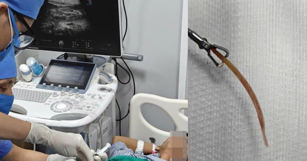 Đau bụng suốt 10 ngày, bất ngờ phát hiện tăm tre đâm thủng đại tràng