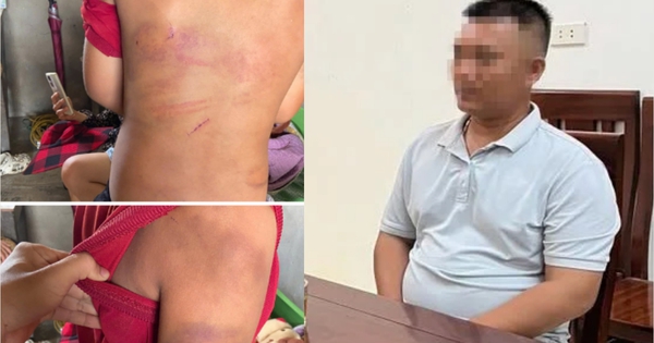 Vụ bé trai 10 tuổi người thâm tím nghi bị bạo hành