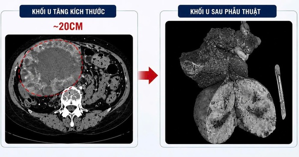 Khối u gan “lớn nhanh như thổi”, tăng kích thước 10 lần sau khi uống loại nước này thường xuyên