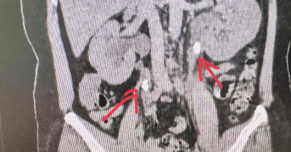 Bác sĩ giật mình khi xem hình ảnh CT thận của bệnh nhân