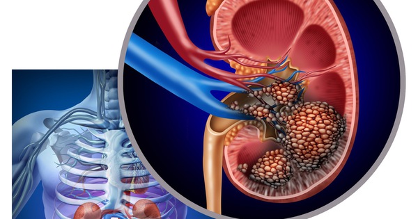 Người đàn ông bất ngờ phát hiện ung thư thận khi đi khám sức khỏe định kỳ: Tôi mới 32 tuổi, sao có thể...