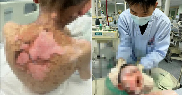 Bé trai 9 tuổi bong tróc da, loét khắp cơ thể, vảy dính kín 