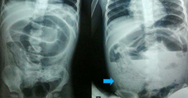 Bé trai đau bụng dữ dội, nôn ói suốt 3 ngày: Bác sĩ mổ khẩn,