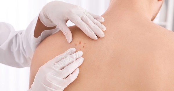Đây là dấu hiệu sớm nhất của ung thư da nhưng rất hay bị bỏ qua