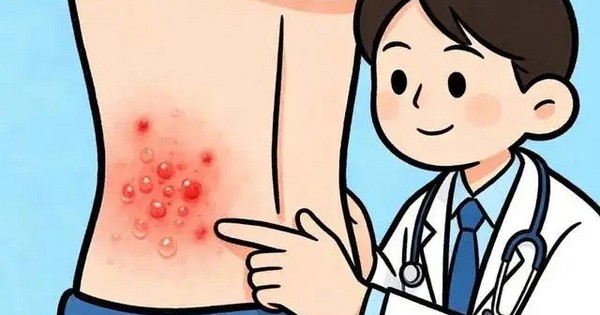 Đau đến mất ngủ nhiều đêm, bệnh zona thần kinh không còn là "bệnh người già": Cảnh báo 4 dấu hiệu miễn dịch suy yếu mà người trẻ bỏ qua