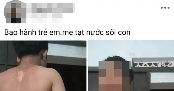 Công an vào cuộc vụ bé trai ở Đắk Lắk nghi bị mẹ tạt nước sôi