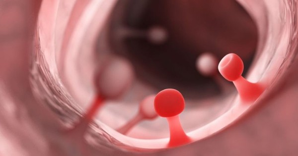 3 người đàn ông trong một gia đình cùng mắc ung thư đại trực tràng: Bác sĩ Bệnh viện Bạch Mai cảnh báo