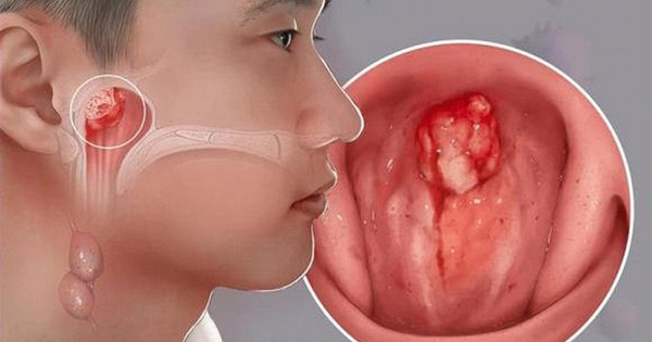 Con bị ù tai thôi mà... và cú sốc của gia đình khi bé trai 14 tuổi được chẩn đoán ung thư giai đoạn tiến triển