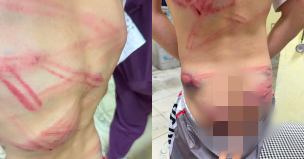 Bé trai 9 tuổi nhập viện với nhiều vết bầm tím: Lời khai của người cha sau khi thừa nhận đánh con gây phẫn nộ