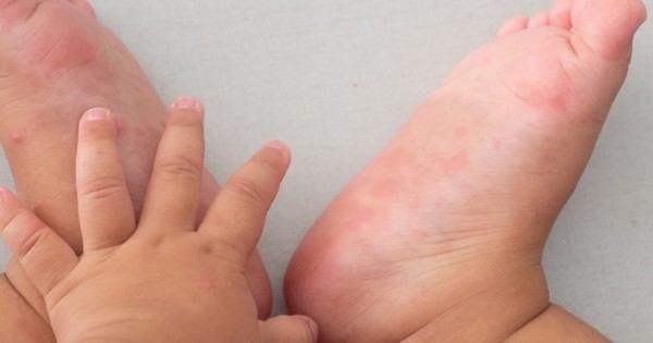 Ca mắc tay chân miệng tăng, chuyên gia khuyến cáo '3 sạch' để phòng bệnh