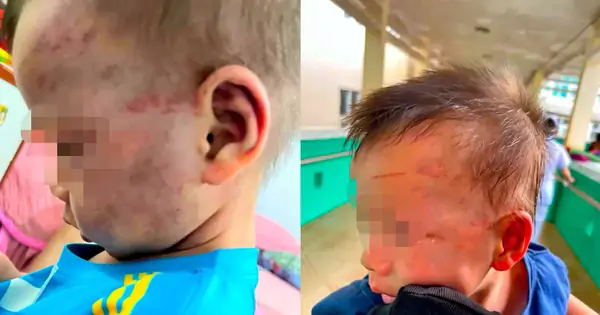 Khởi tố cha dượng đánh bé 3 tuổi bầm tím mặt mũi