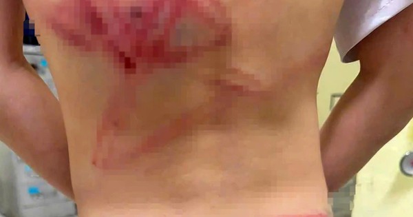 Không khởi tố cha đánh con trai 9 tuổi bầm tím khắp người ở Quảng Trị