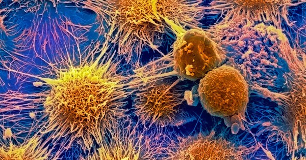 Tưởng bị viêm nhiễm, đi khám bàng hoàng phát hiện ung thư: Bác sĩ cảnh báo dấu hiệu nhiều người dễ bỏ qua