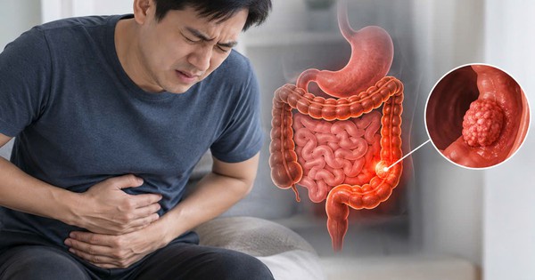 Bác sĩ bệnh viện Bạch Mai cảnh báo 4 DẤU HIỆU ung thư đường tiêu hóa: Nhiều người gặp nhưng chủ quan bỏ qua