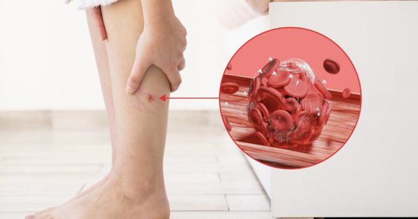 Bất kể giới tính, nếu điều này xuất hiện trên chân, đó có thể là dấu hiệu của cục máu đông trong cơ thể