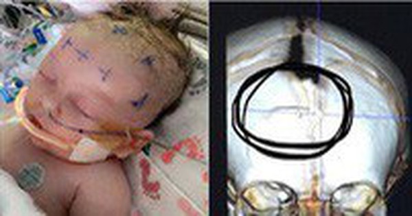 Hình ảnh em bé 7 tuần tuổi co giật, chảy máu não cho thấy vì sao luôn cần bảo vệ thóp trẻ sơ sinh thật cẩn thận