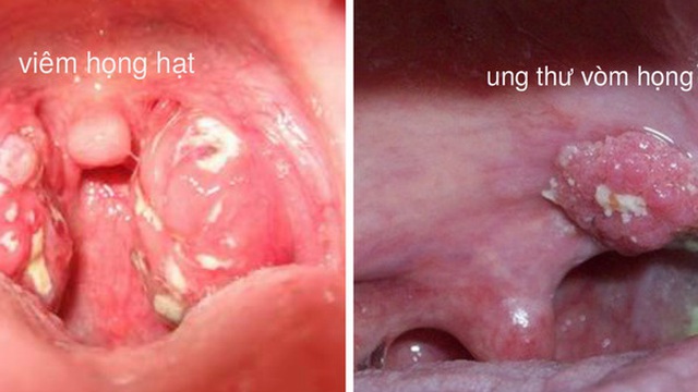 Yếu tố nào dẫn đến ung thư vòm họng?