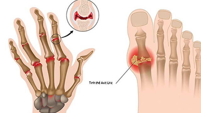 Gout - căn bệnh của giới nhà giàu?
