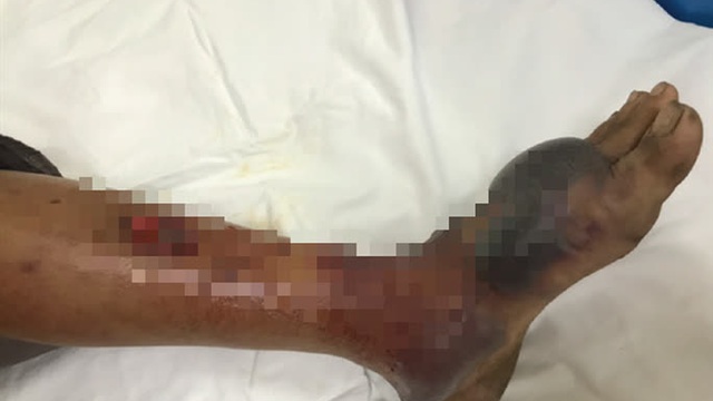 Một ngư dân bị sốc nhiễm trùng da nặng do vi khuẩn "ăn thịt người"