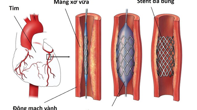 Yêu cầu báo cáo việc bệnh nhân đặt stent động mạch vành từ năm 2015 đến nay