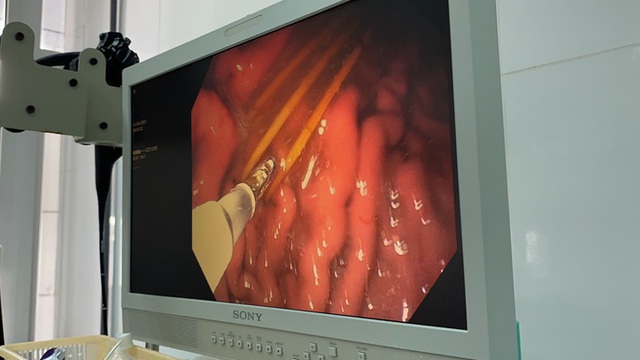Lấy cùng lúc 3 cây tăm tre trong dạ dày bệnh nhân