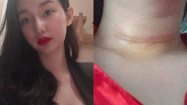 MC Quỳnh Chi phải phẫu thuật vì phát hiện tế bào ung thư tuyến giáp, vết sẹo lớn để lại trên cổ gây xót xa