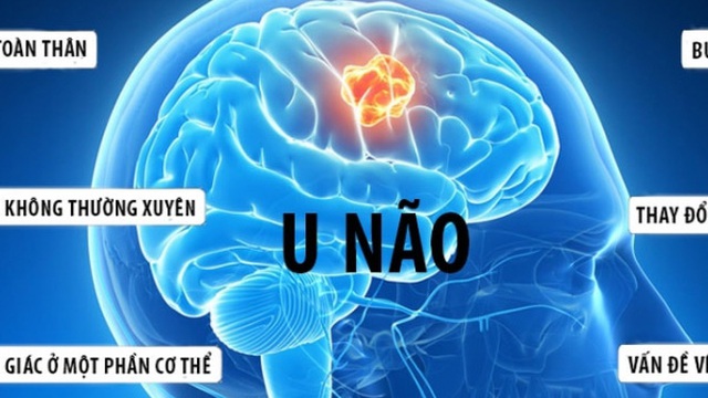 9 dấu hiệu cảnh báo u não ở trẻ em, cha mẹ chớ bỏ qua