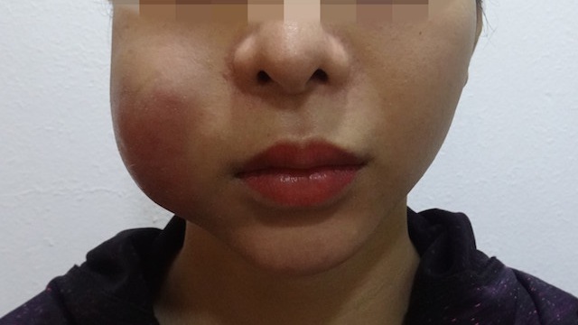 Tiêm filler làm đẹp hết 40 triệu, cô gái bị hoại tử má không ai nhận sửa