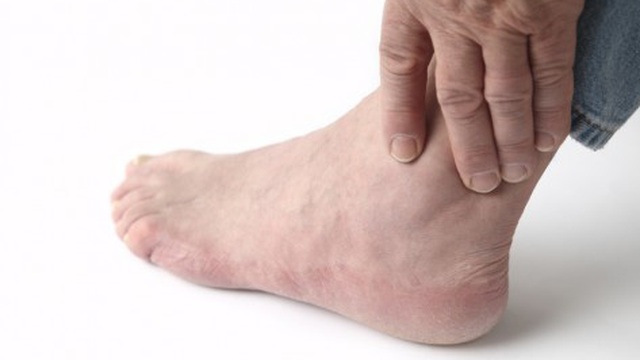 Biểu hiện khi bị gout như thế nào?