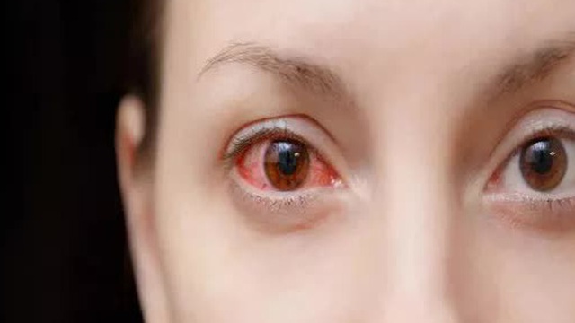 Cảnh báo 5 dấu hiệu nhiễm trùng mắt liên quan đến COVID-19