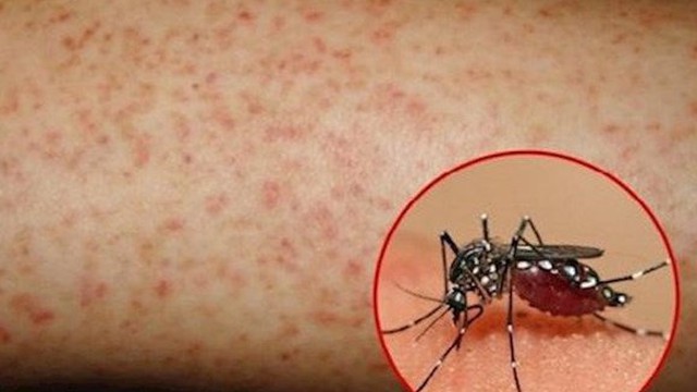 Chuyên gia chỉ cách ngăn muỗi gây bệnh sốt xuất huyết