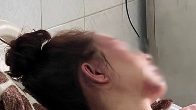 Cán bộ QLTT đánh bạn gái dập mũi, vỡ hàm, chảy máu mắt vì hát song ca với người khác
