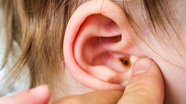 Biến chứng đáng sợ của viêm tai giữa và cách phòng tránh từ chuyên gia