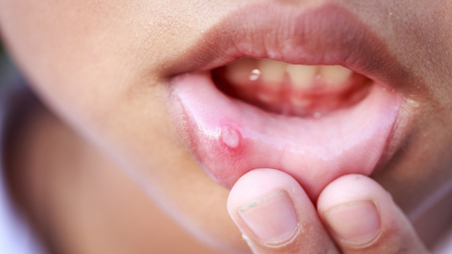 Người đàn ông phải cắt bỏ 1/4 lưỡi vì ung thư: Bác sĩ cảnh báo dấu hiệu dễ bị bỏ qua