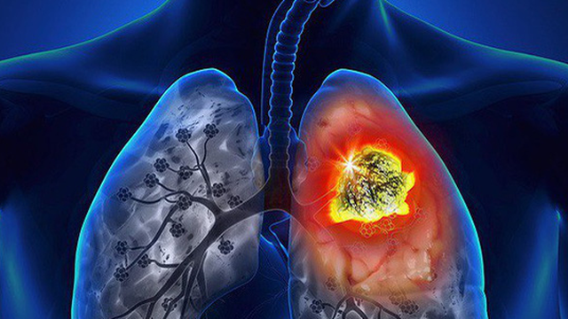 Phát hiện khối u ác tính ở phổi sau thời gian dài bị ho
