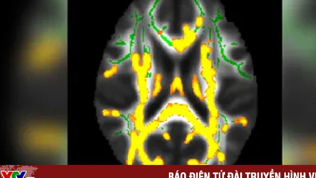 Nghiên cứu cho thấy mỡ bụng ẩn có liên quan đến viêm não và chứng mất trí nhớ